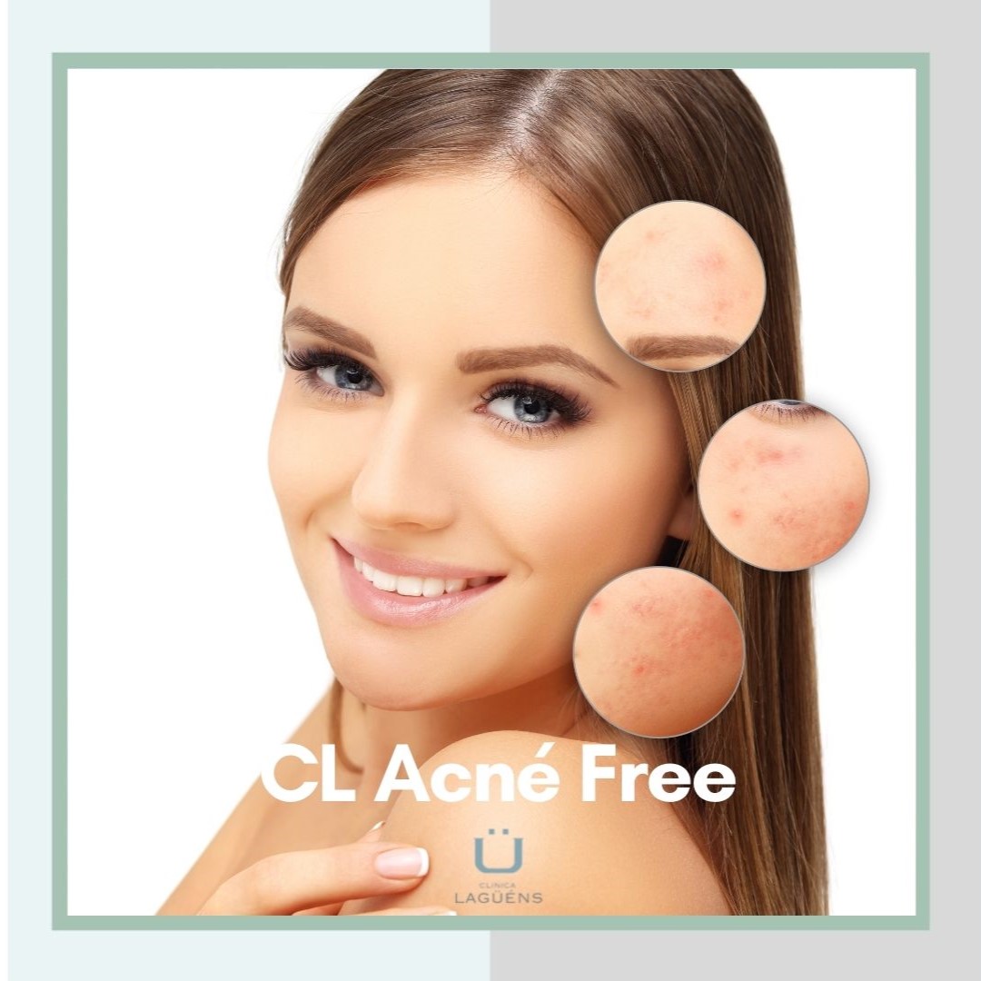 tratamiento del acné en sevilla 